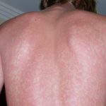 Klassinen homeopaatti, Helsinki, Jaana Kolehmainen, iho-oireet ja ihottuma